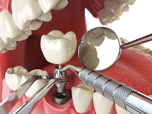 Best Dental Abscess Treatment in Hughesville, MD